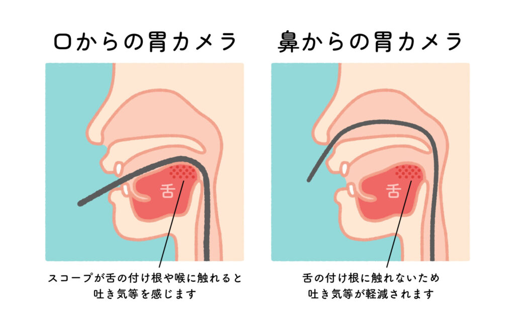 【イラスト】口からの胃カメラ・鼻からの胃カメライメージ
